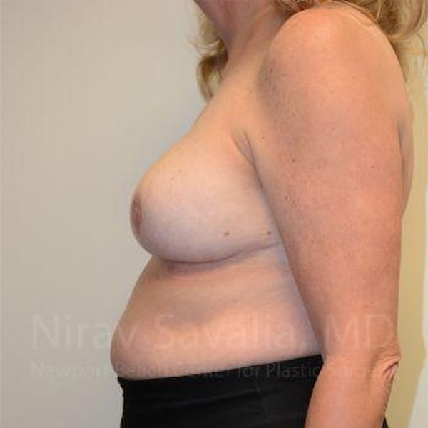 Breast Reduction Before & After Gallery - Patient 1655533 - Image 4