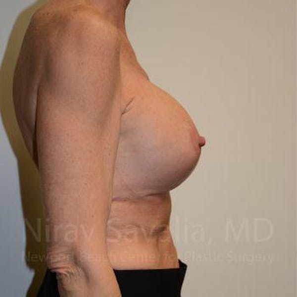 Breast Lift with Implants Before & After Gallery - Patient 1655532 - Image 6