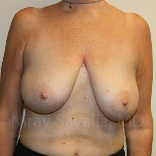 Breast Reduction Before & After Gallery - Patient 1655534 - Image 1