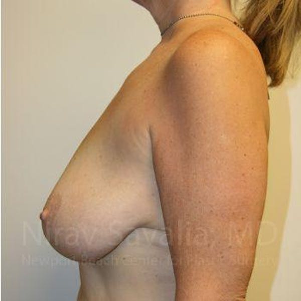 Breast Reduction Before & After Gallery - Patient 1655534 - Image 3