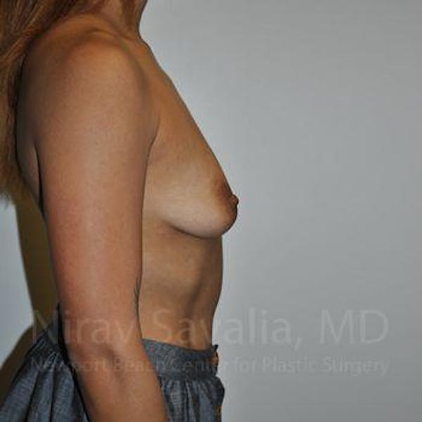 Breast Augmentation Before & After Gallery - Patient 1655537 - Image 3