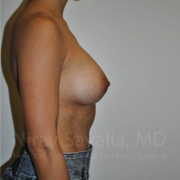 Breast Augmentation Before & After Gallery - Patient 1655537 - Image 4
