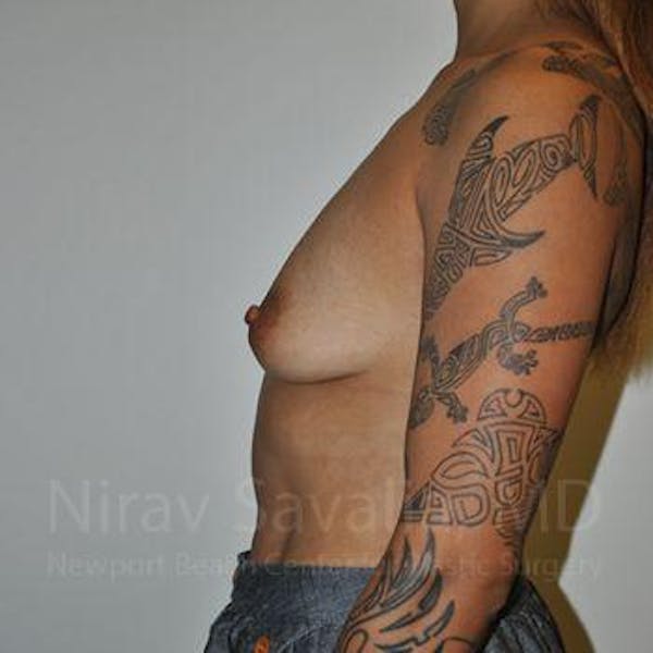 Breast Augmentation Before & After Gallery - Patient 1655537 - Image 9