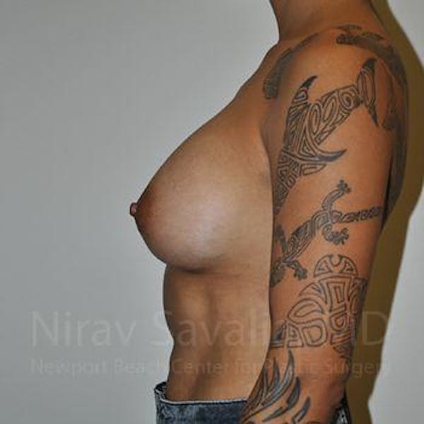 Breast Augmentation Before & After Gallery - Patient 1655537 - Image 10