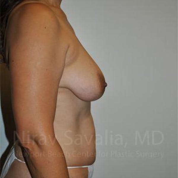 Breast Lift with Implants Before & After Gallery - Patient 1655542 - Image 3