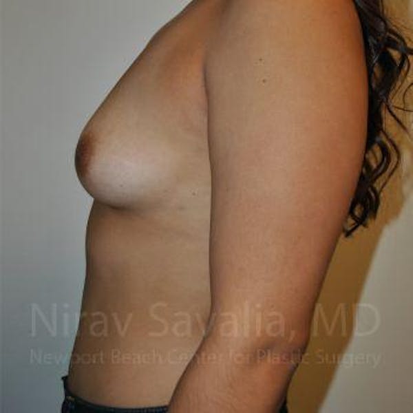 Breast Augmentation Before & After Gallery - Patient 1655544 - Image 5
