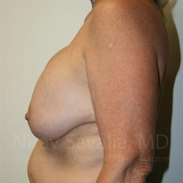 Breast Implant Revision Before & After Gallery - Patient 1655545 - Image 3