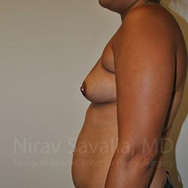 Breast Augmentation Before & After Gallery - Patient 1655546 - Image 9