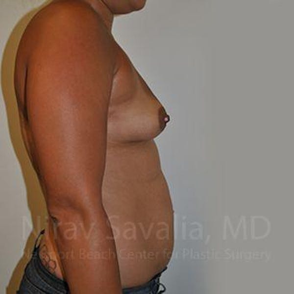 Breast Augmentation Before & After Gallery - Patient 1655546 - Image 11