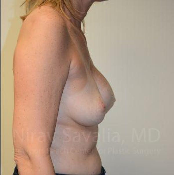 Breast Implant Revision Before & After Gallery - Patient 1655547 - Image 3