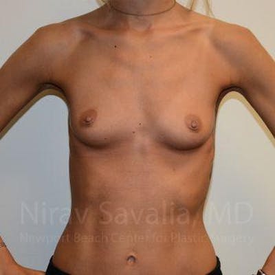 Breast Augmentation Before & After Gallery - Patient 1655548 - Image 1