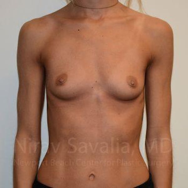 Breast Augmentation Before & After Gallery - Patient 1655548 - Image 3