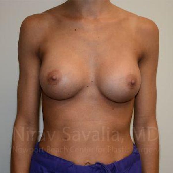 Breast Augmentation Before & After Gallery - Patient 1655548 - Image 4