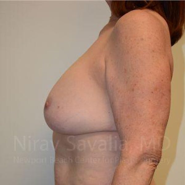 Breast Implant Revision Before & After Gallery - Patient 1655549 - Image 3