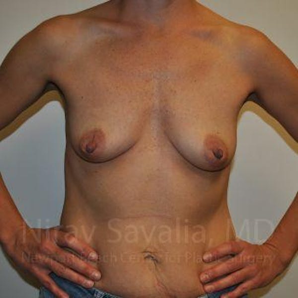 Breast Augmentation Before & After Gallery - Patient 1655550 - Image 3