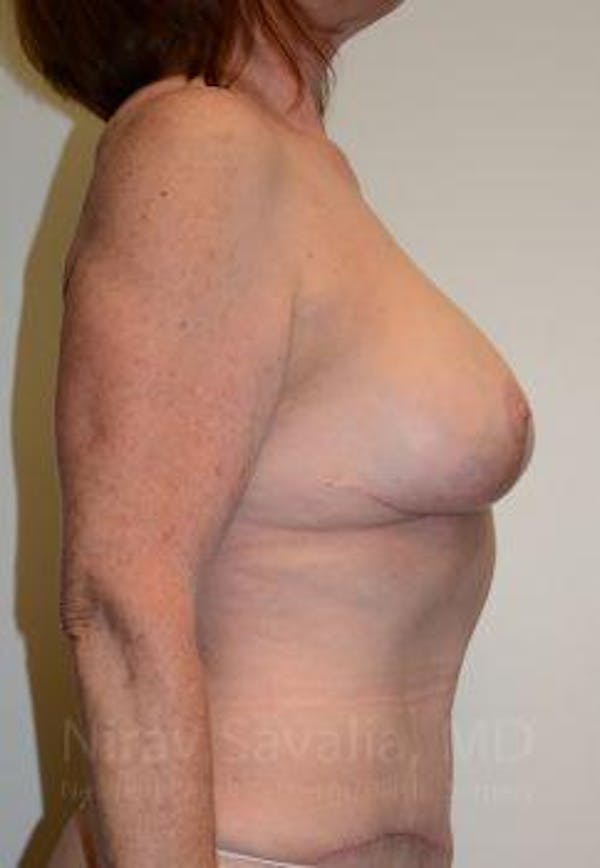 Breast Implant Revision Before & After Gallery - Patient 1655549 - Image 6