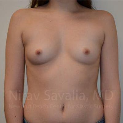 Breast Augmentation Gallery - Patient 1655555 - Image 1