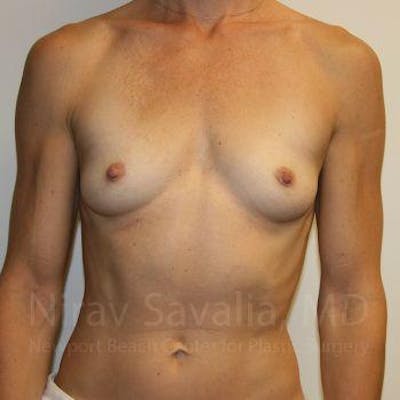 Breast Augmentation Before & After Gallery - Patient 1655561 - Image 1