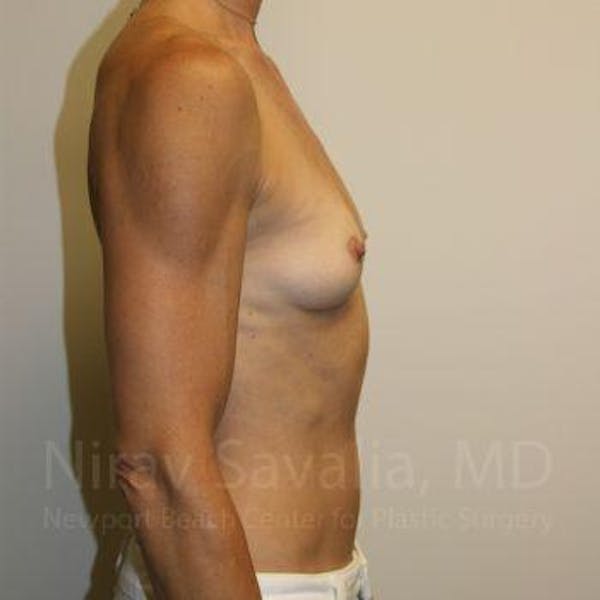 Breast Augmentation Before & After Gallery - Patient 1655561 - Image 5