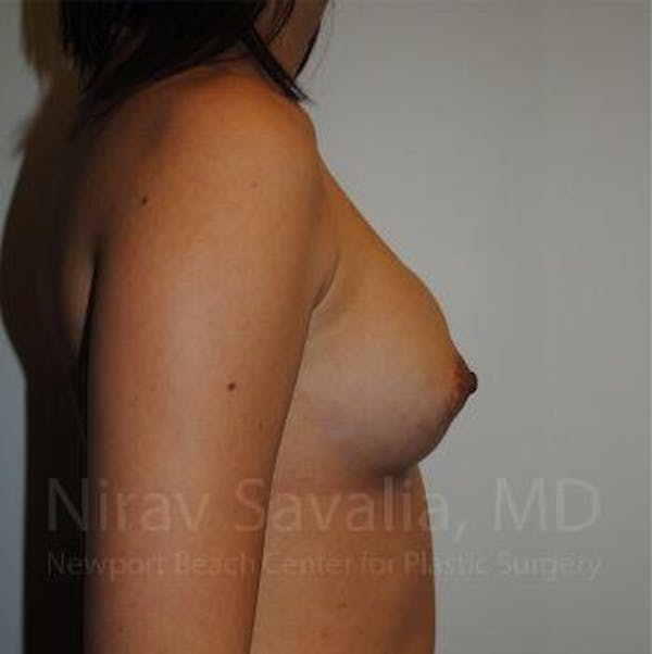 Breast Implant Revision Before & After Gallery - Patient 1655564 - Image 5
