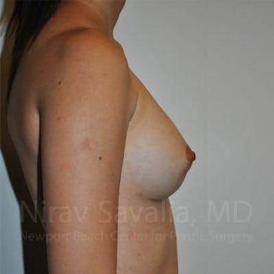 Breast Implant Revision Before & After Gallery - Patient 1655564 - Image 6