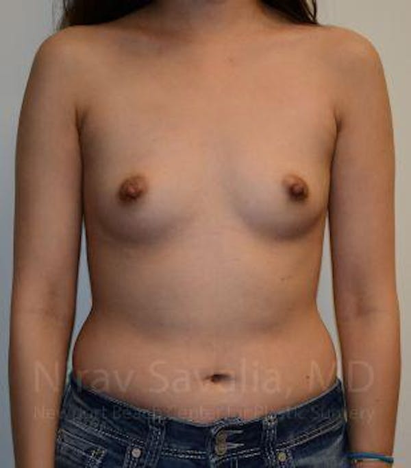 Breast Augmentation Before & After Gallery - Patient 1655566 - Image 1
