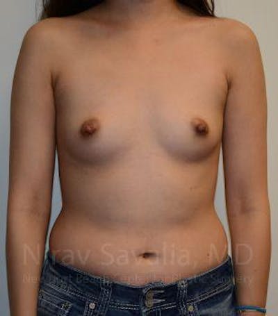 Breast Augmentation Before & After Gallery - Patient 1655566 - Image 1