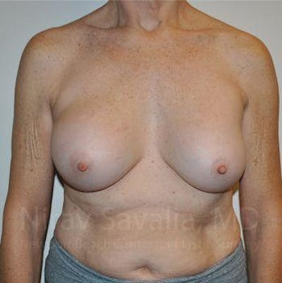 Breast Implant Revision Gallery - Patient 1655567 - Image 1