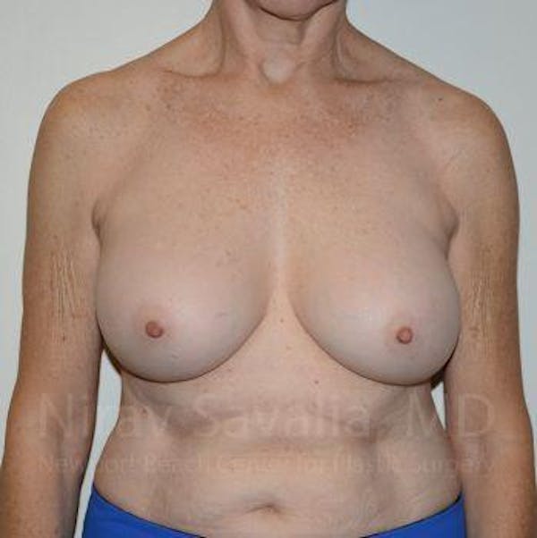 Breast Implant Revision Gallery - Patient 1655567 - Image 2