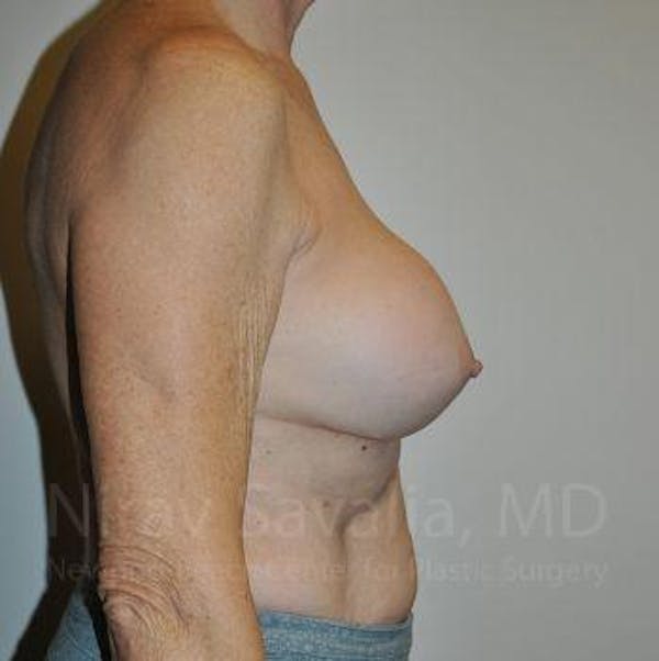 Breast Implant Revision Before & After Gallery - Patient 1655567 - Image 3