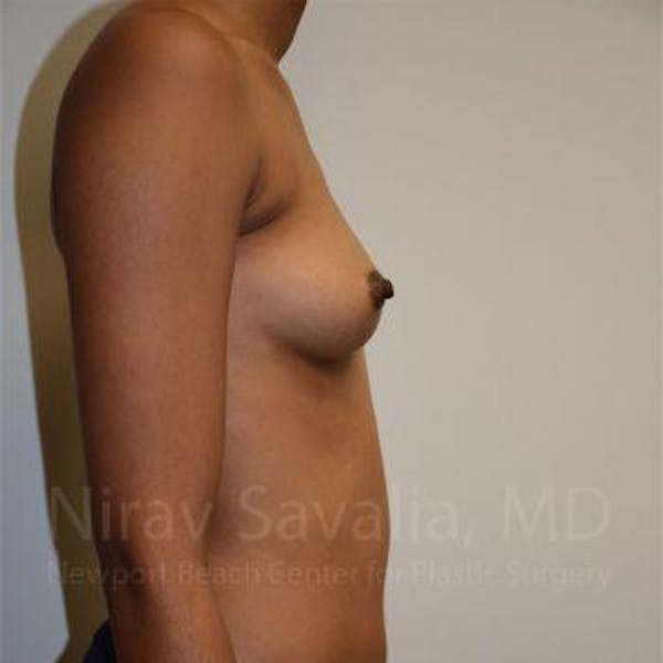 Breast Augmentation Before & After Gallery - Patient 1655568 - Image 3
