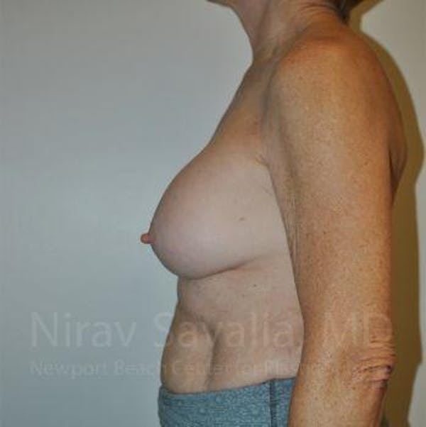 Breast Implant Revision Before & After Gallery - Patient 1655567 - Image 5