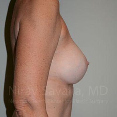 Breast Implant Revision Before & After Gallery - Patient 1655570 - Image 6