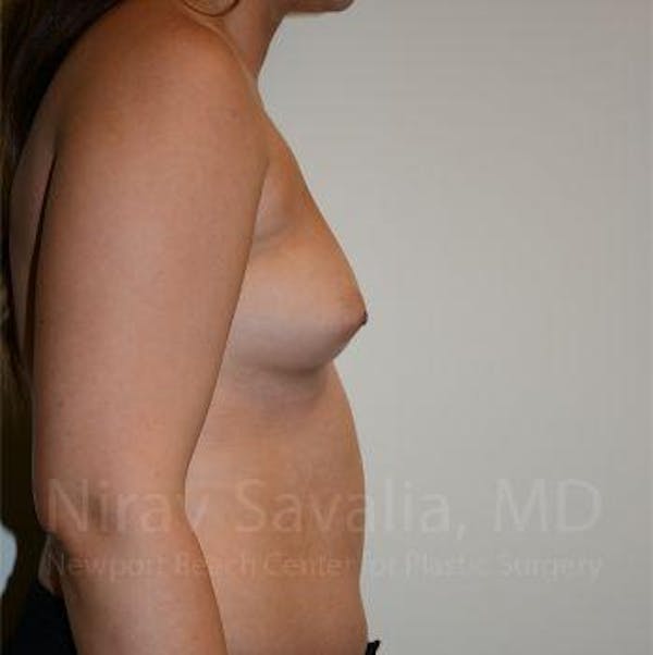 Breast Augmentation Before & After Gallery - Patient 1655571 - Image 7