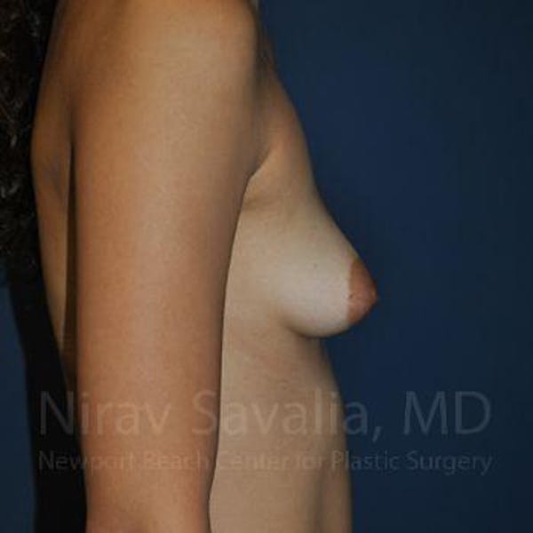 Breast Augmentation Before & After Gallery - Patient 1655573 - Image 5
