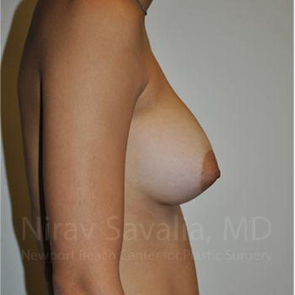 Breast Augmentation Before & After Gallery - Patient 1655573 - Image 6