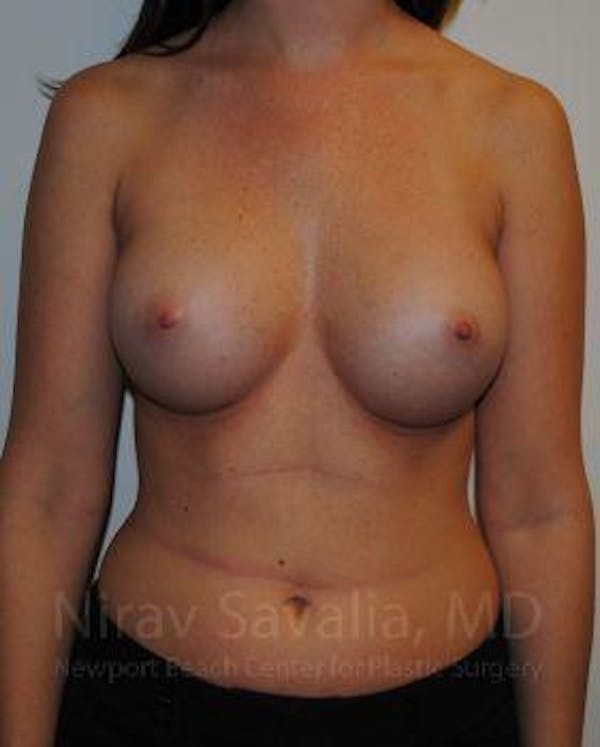 Breast Augmentation Before & After Gallery - Patient 1655574 - Image 2