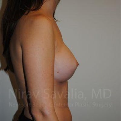 Breast Augmentation Before & After Gallery - Patient 1655574 - Image 6