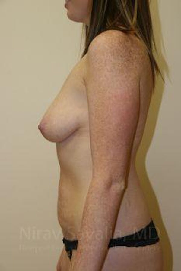 Breast Augmentation Before & After Gallery - Patient 1655579 - Image 5