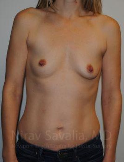 Breast Augmentation Before & After Gallery - Patient 1655580 - Image 1