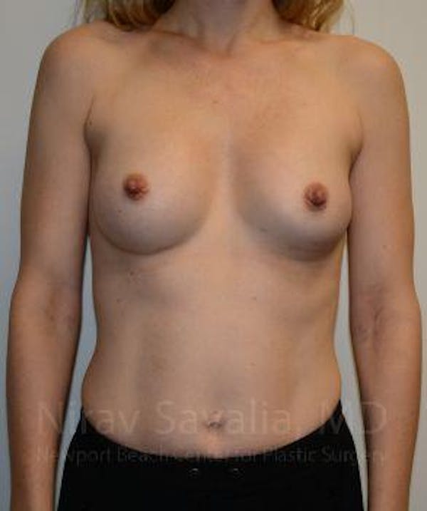 Breast Augmentation Before & After Gallery - Patient 1655580 - Image 2
