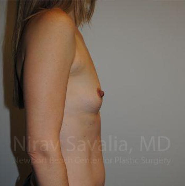 Breast Augmentation Before & After Gallery - Patient 1655580 - Image 3