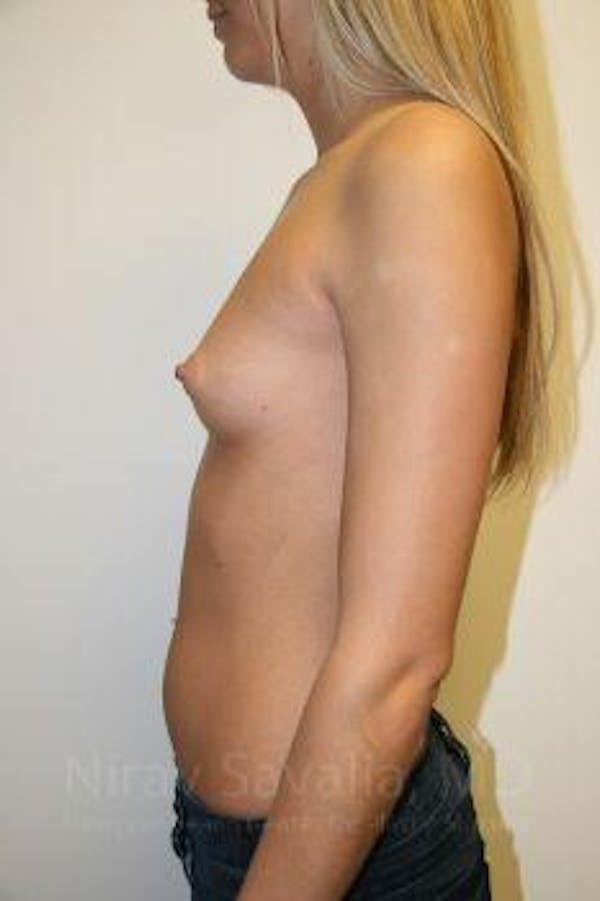 Breast Augmentation Before & After Gallery - Patient 1655581 - Image 3
