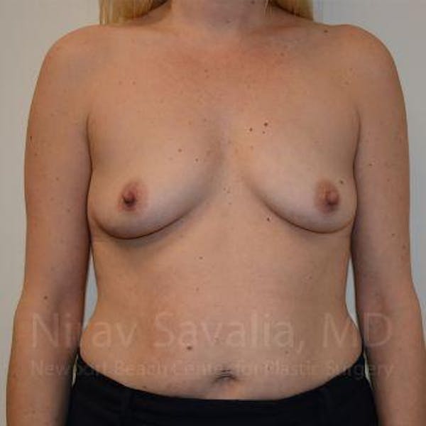 Breast Augmentation Before & After Gallery - Patient 1655585 - Image 1