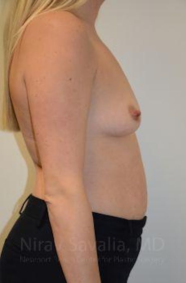 Breast Augmentation Before & After Gallery - Patient 1655585 - Image 5