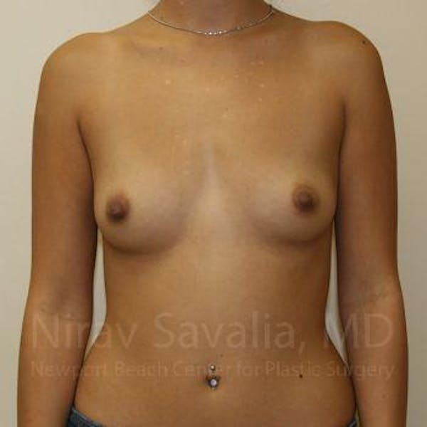 Breast Augmentation Before & After Gallery - Patient 1655586 - Image 1