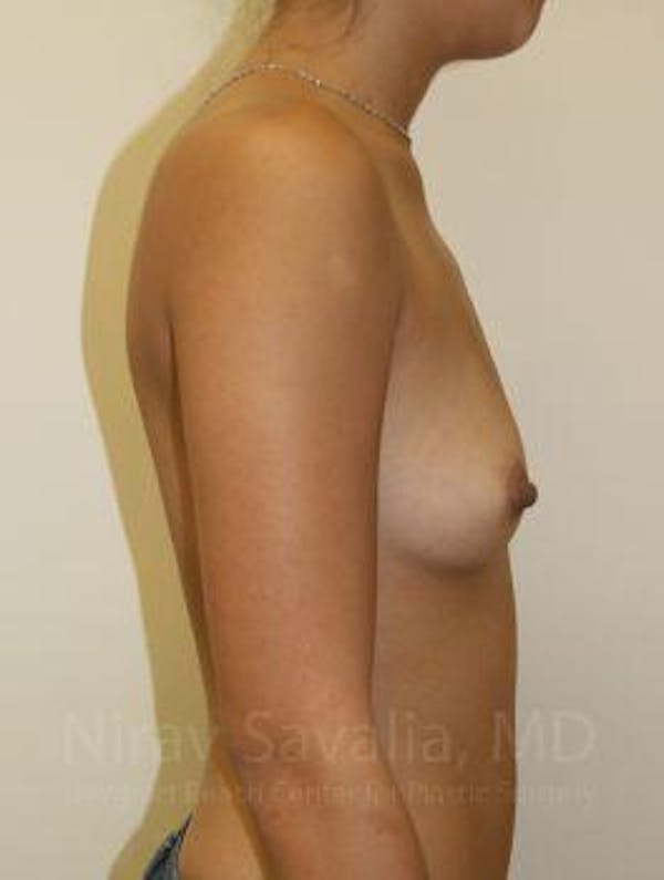 Breast Augmentation Before & After Gallery - Patient 1655586 - Image 3