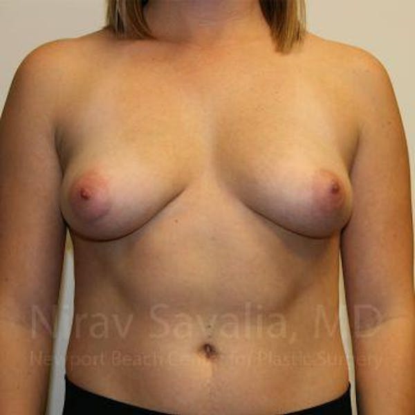 Breast Augmentation Before & After Gallery - Patient 1655593 - Image 1