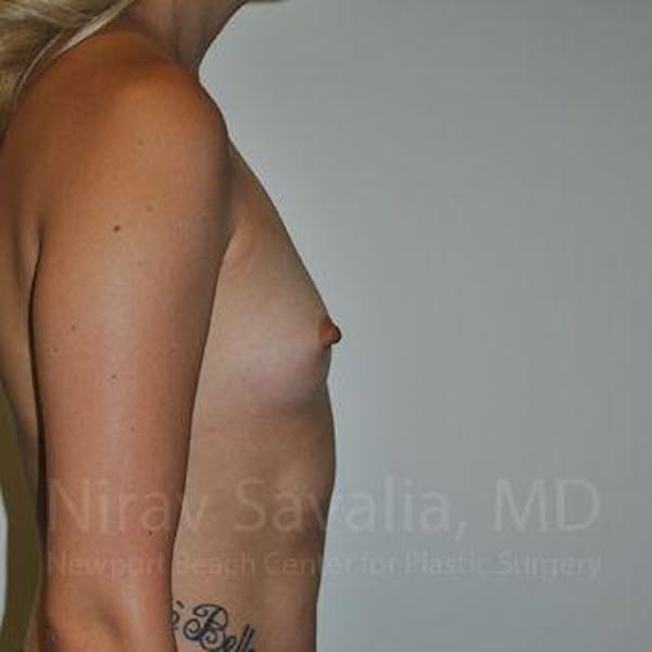 Breast Augmentation Before & After Gallery - Patient 1655595 - Image 3