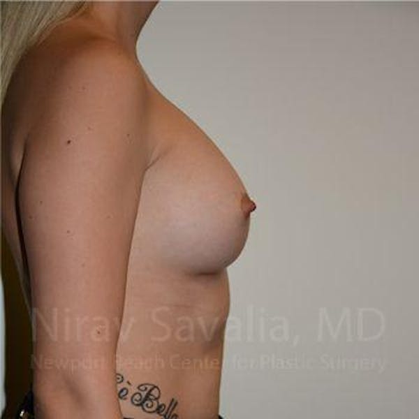 Breast Augmentation Before & After Gallery - Patient 1655595 - Image 4